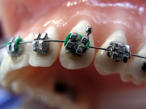 Montering av rälsen på tänderna