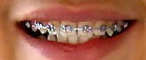Dental_Braces